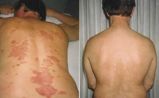 Psoriasis behandling hos Ny Energi