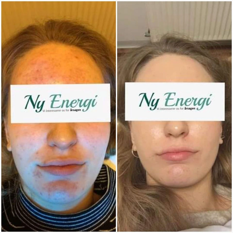 Acne behandling hos Ny Energi
